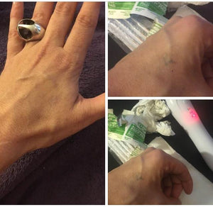 Tattoo Removal Tool - At Home Face Lift - Skin Tightening Tool - Freckle Remover - Mole Remover - Dark Spot Remover